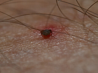 A tick (Ixodes ricinus) has bitten on the leg and there is a red spot around it