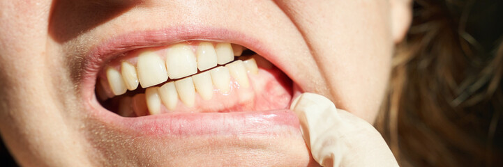 Fototapeta premium Close-up of female adult caucasian mouth with healthy teeth and dentists gloved hand examining gums.