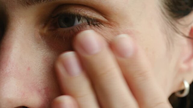 Close up young woman face applying moisturizing or healing cream to her problematic skin with acne, red spots, and dilated capillaries for healthy skincare routine. Woman applying cream on acne skin