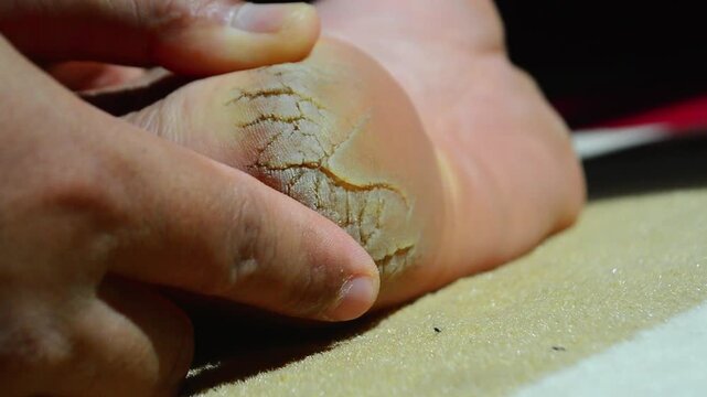 Close-up of badly cracked heel. Persons feet with dry skin. Barefoot man with unattractive and unhealthy foot. Salon treatment and skin procedure needed concept. Cracked dry skin,  Foot treatment.
