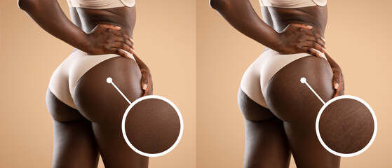 Collage displays before and after results of cellulite and stretch mark treatment on hips....