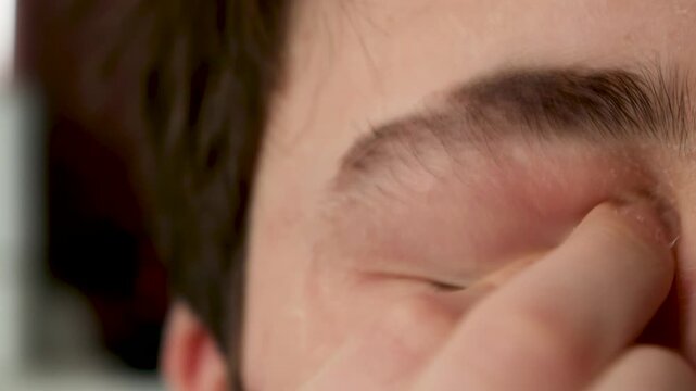 Allergic patient rubbing and itching eyes with hands. Itch caused by atopic dermatitis and allergy