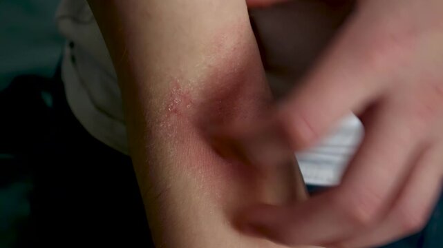Atopic dermatitis on a child's elbow crease, scratching irritated and itchy red skin
