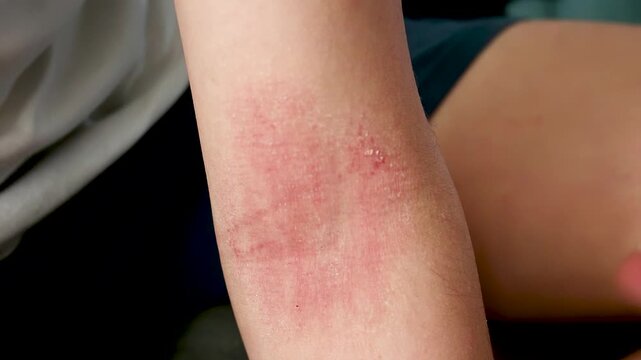 Applying healing cream to the skin on the elbow crease with atopic dermatitis