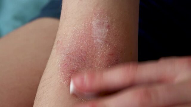 Applying healing cream to irritated skin on a child's elbow crease with atopic dermatitis. Treatment with clean hands