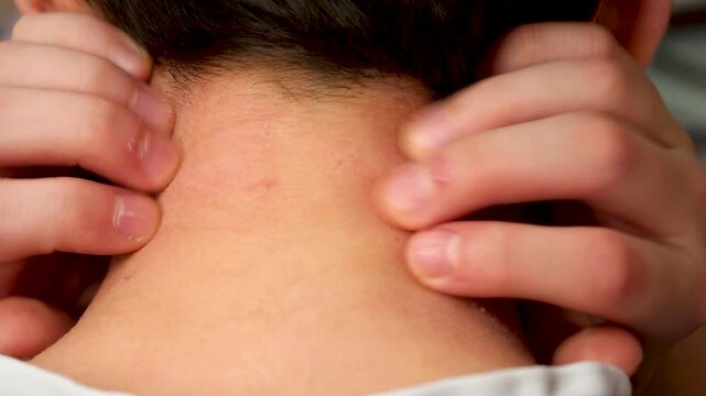 Patient with atopic dermatitis scratching irritation and itch on the back of the neck. Allergy symptoms.