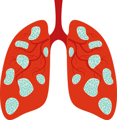 Pneumonia Illustration