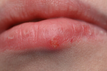 Obraz premium Macro close-up of a cold sore on the lips, early stage, HSV-1