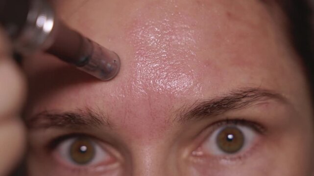Woman using dermapen on face, cheeks, forehead and around the mouth. Female with pigmentation spots and rosacea taking care of her skin at home. Concept of skincare and facial rejuvenation.
