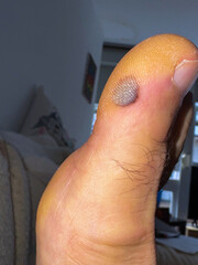 Closeup of toe with bruised blister in home setting