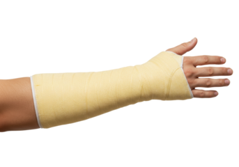 Isolated arm cast, healthcare injury protection, support for bone healing following a fracture