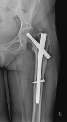 Left Hip Radiograph Showing Intramedullary Nail Fixation of Proximal Femoral Fracture –...