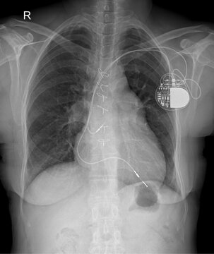 Chest Radiograph Showing Implanted Pacemaker Cardiac Device Placement