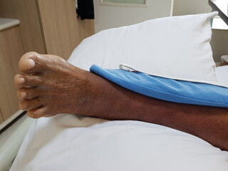 Purpura caused by cancer on leg is side effect of chemotherapy or caused by cancer cells...