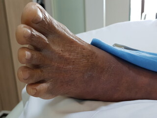 Purpura caused by cancer on leg is side effect of chemotherapy or caused by cancer cells interfering with platelet production in the bone marrow.