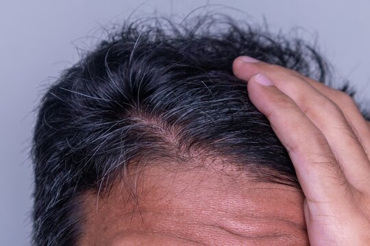 Hair problems concept. An Asian man with gray hair. White hair growing up.