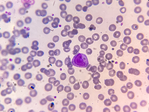 Leukemia cells, Neutrophil , Lymphocyte in blood smear.