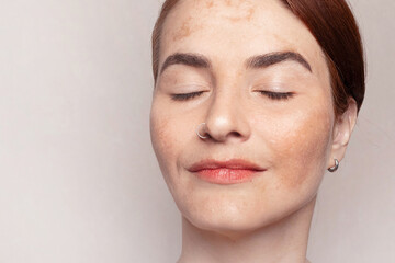 Close up photo with woman's face with pigmentation, melasma, freckles, age spots photo. copy space