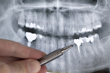Doctor learning Panoramic dental X-Ray of humans teeth with Teeth implant. Dental post. Diseased...