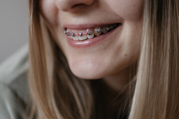woman shows off her teeth with braces. Suitable for topics such as health, medicine, and dentistry.