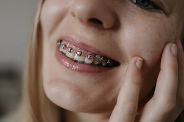 woman shows off her teeth with braces. Suitable for topics such as health, medicine, and dentistry.