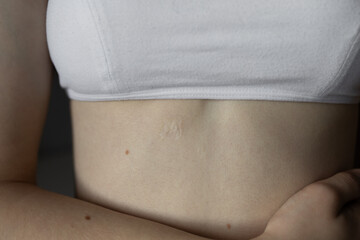 girl in white top with scar on her body from surgery Concept of medicine, health, beauty, psychology