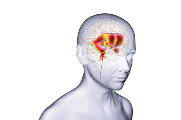 Normal pressure hydrocephalus, 3D illustration