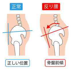 反り腰の骨盤前傾と正常な骨盤の位置