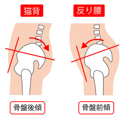 猫背の骨盤後傾と反り腰の骨盤前傾