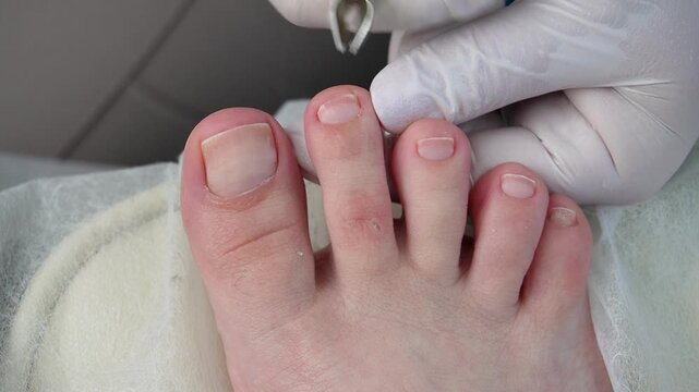 The podologist treats the toenails and cuticles on the patient's feet