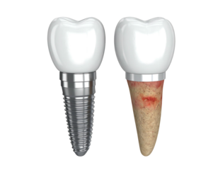 Two dental implants displayed against a black backdrop, one clean and the other with gum infection