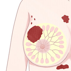 Blank Breast cancer Stage 4 diagram Human anatomy PNG