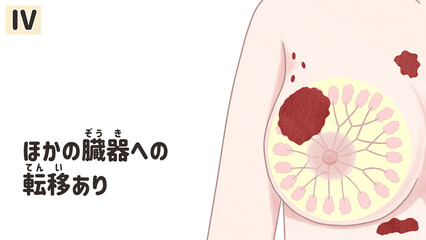 Breast cancer Stage 4 diagram Human anatomy PNG