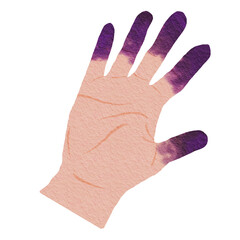 Illustration of Hand with Raynaud's Syndrome Symptoms