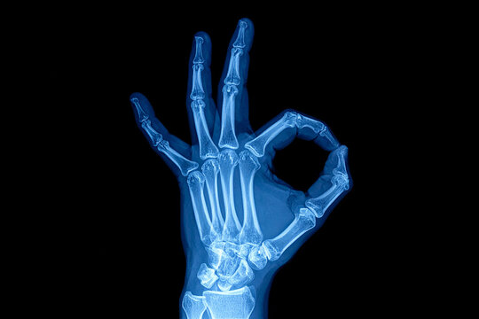 an X-rayed hand making the OK gesture with its fingers