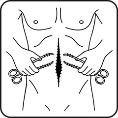 Traditional Open Surgery