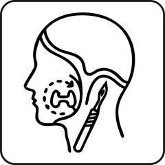 Removal of the tonsil