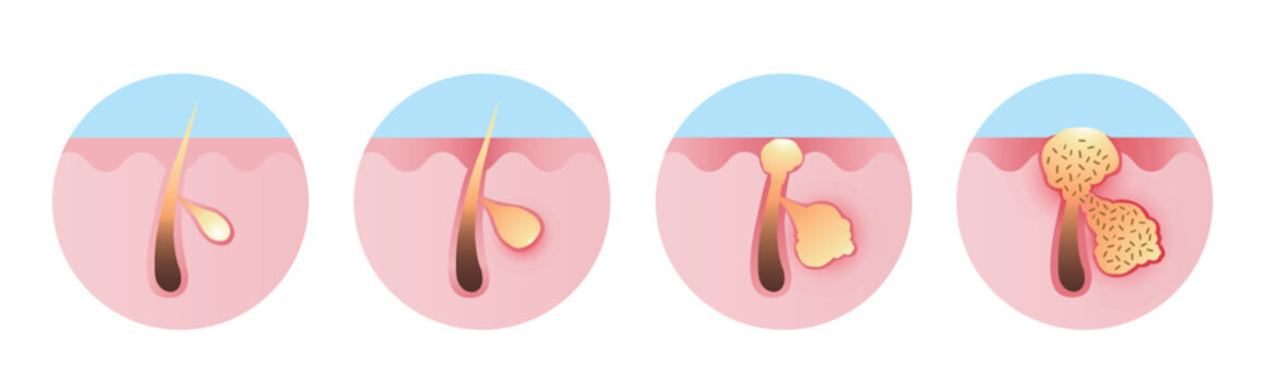 Inflammation acne process vector icon set illustration on white background. From micro inflammation to visible inflammatory acne, papule, pustule, blister or pimple on the skin inflamed, contain pus.