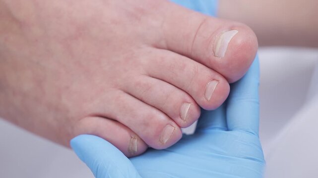 Close-up of toenails examined by gloved hand during foot health check, podiatrist treatment.