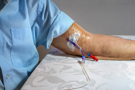 An old man is sitting at his kitchen table getting antibiotics infusion via double lumen PICC (Peripherally Inserted Central venous Catheter) at home