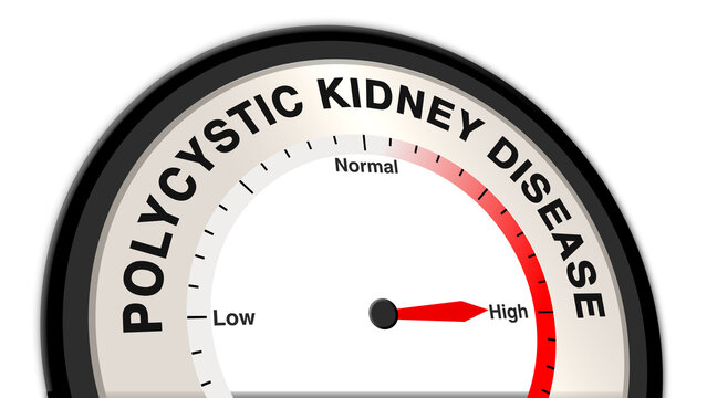 Polycystic kidney disease at high severity displayed on a barometer or tachometer, indicating severe kidney dysfunction, urgent medical intervention, and intensive care management