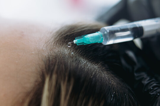 close up on woman head getting mesotherapy injections for stronger and healthier hair