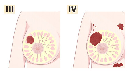 Blank Breast cancer Stages Medical diagram PNG