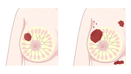 Blank Breast cancer Stages Medical diagram PNG