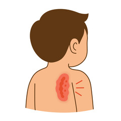 Shingles, from virus herpes zoster at back's man, illustration cartoon on white background