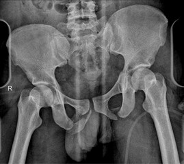 X-ray of Pelvis Showing Fracture 