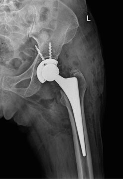 X-ray of Left Hip Showing Total Hip Replacement with Prosthetic Implant and Acetabular Fixation