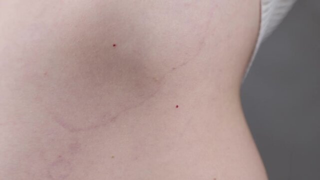 Young woman lifting her sweater to show her skin spots on the belly. Ring-shaped centrifugal erythema of Darya