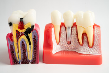 Dental implant, artificial tooth roots into jaw, root canal of dental treatment, gum disease, teeth...