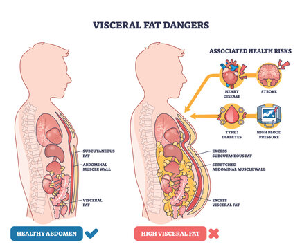 Visceral fat dangers compare healthy vs high-fat abdomens, showing organs, visceral fat around the belly, and risk icons for heart and brain. Outline diagram